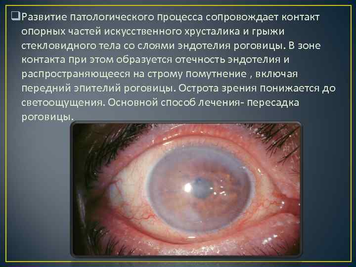 q. Развитие патологического процесса сопровождает контакт опорных частей искусственного хрусталика и грыжи стекловидного тела