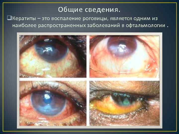 Общие сведения. q. Кератиты – это воспаление роговицы, является одним из наиболее распространенных заболеваний