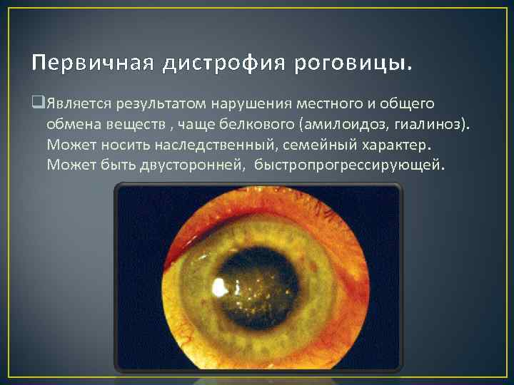 Первичная дистрофия роговицы. q. Является результатом нарушения местного и общего обмена веществ , чаще