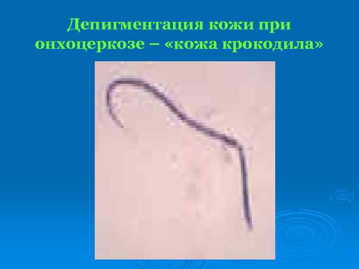   Депигментация кожи при онхоцеркозе – «кожа крокодила» 