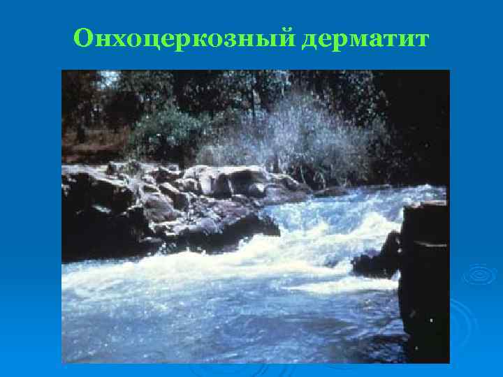 Онхоцеркозный дерматит 