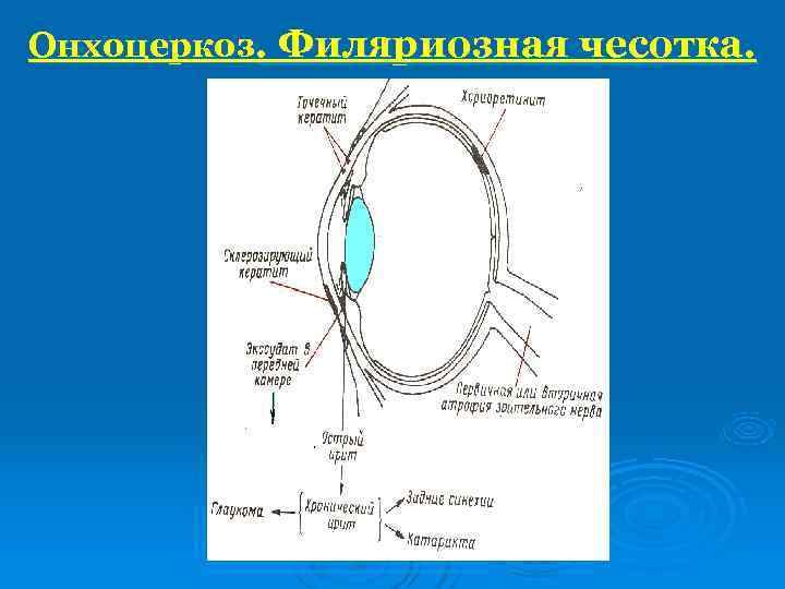 Онхоцеркоз. Филяриозная чесотка. 