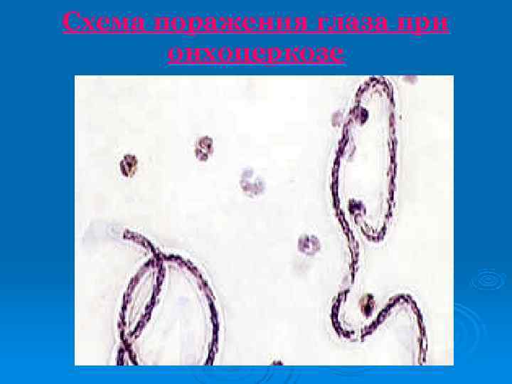Схема поражения глаза при  онхоцеркозе 