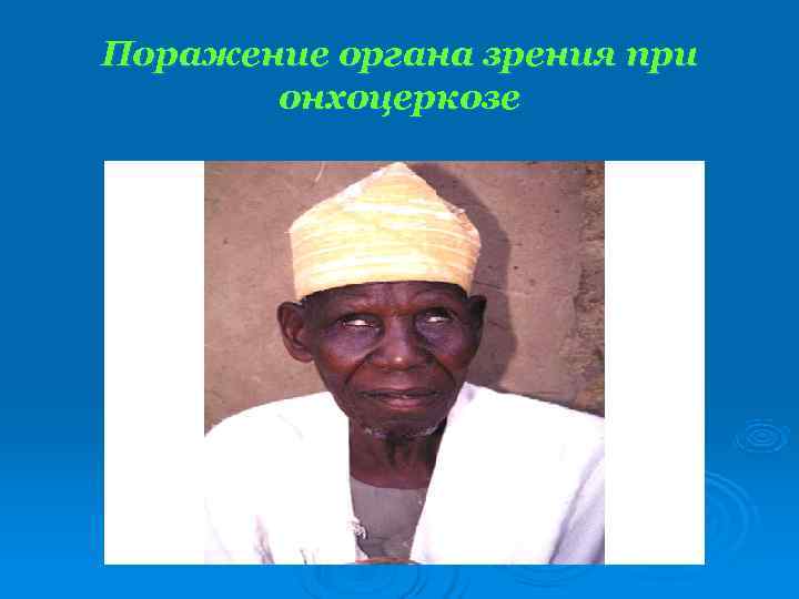 Поражение органа зрения при  онхоцеркозе 
