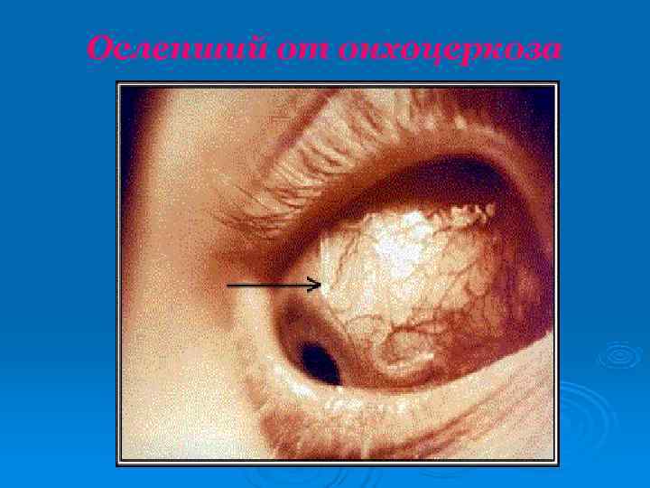 Ослепший от онхоцеркоза 