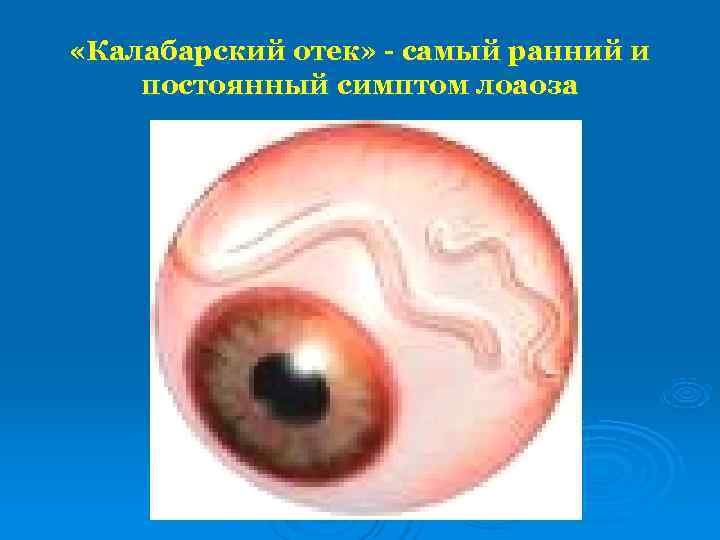  «Калабарский отек» - самый ранний и постоянный симптом лоаоза 