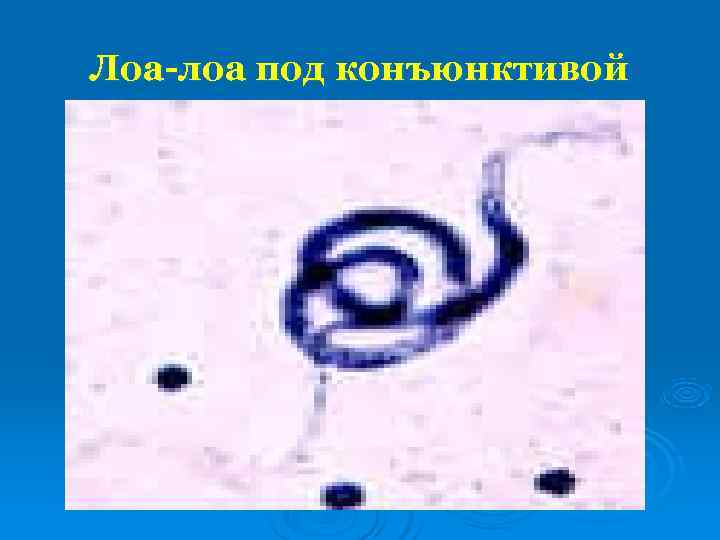 Лоа-лоа под конъюнктивой 