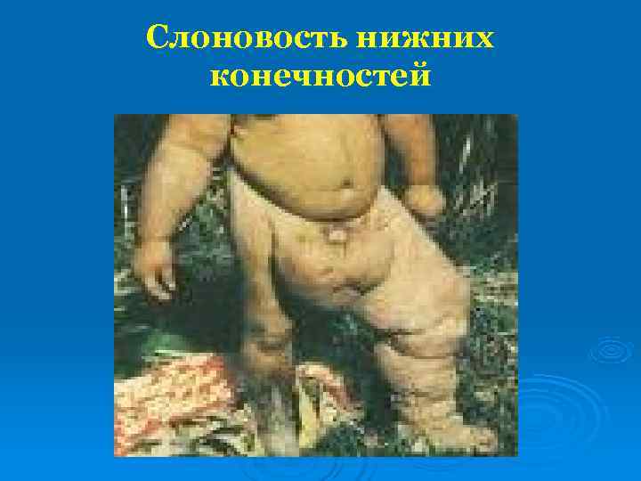 Слоновость нижних  конечностей 