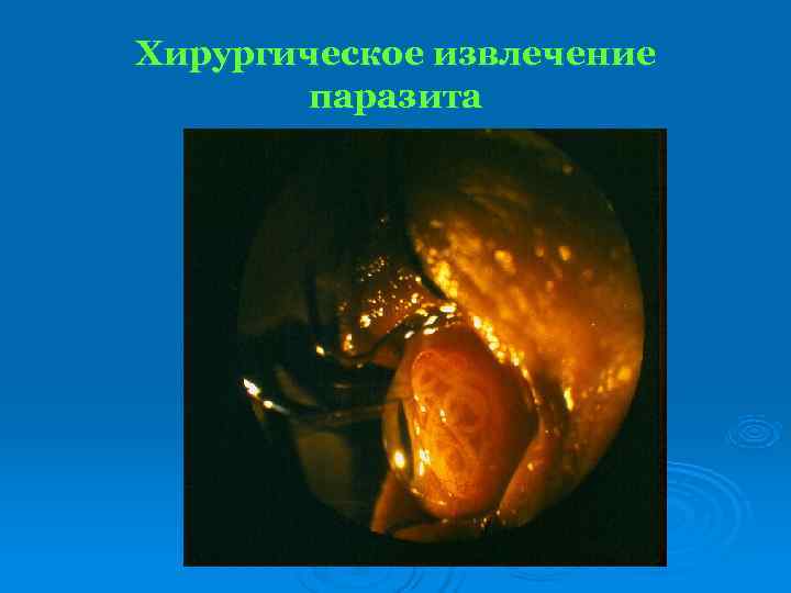 Хирургическое извлечение  паразита 