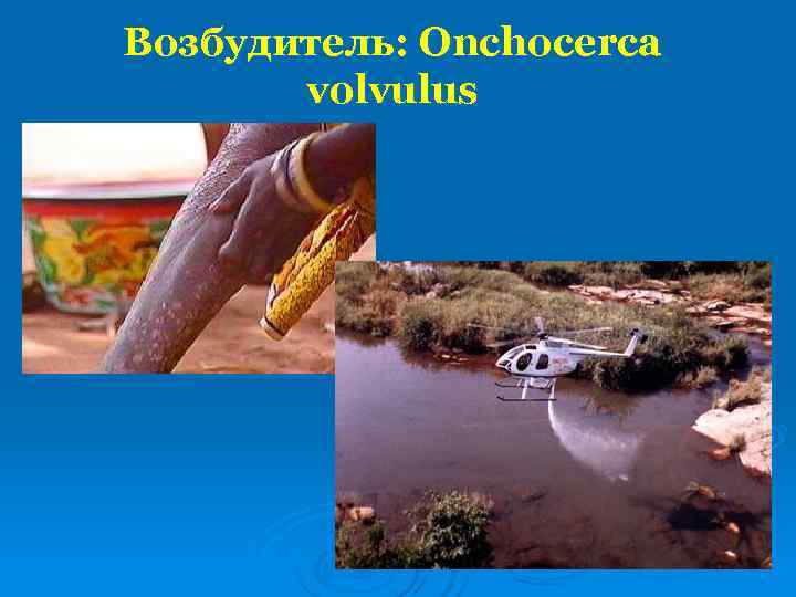 Возбудитель: Onchocerca  volvulus 