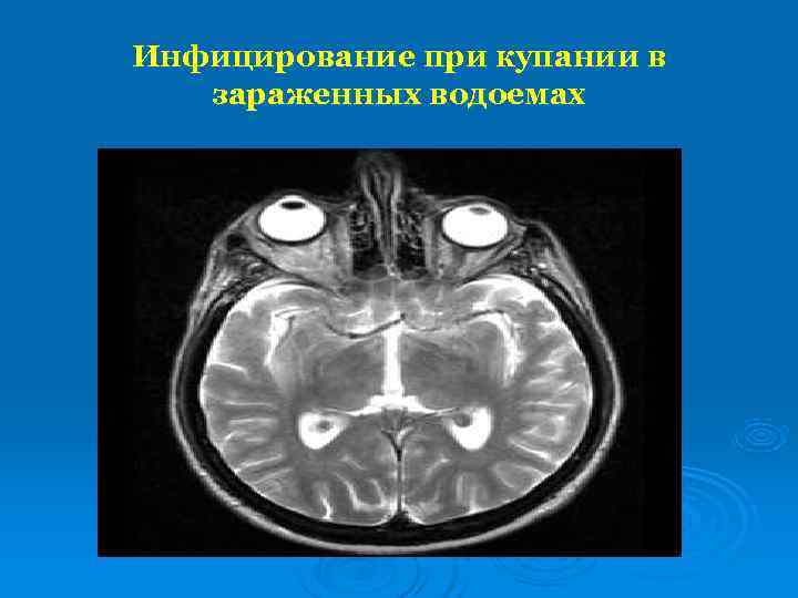 Инфицирование при купании в  зараженных водоемах 