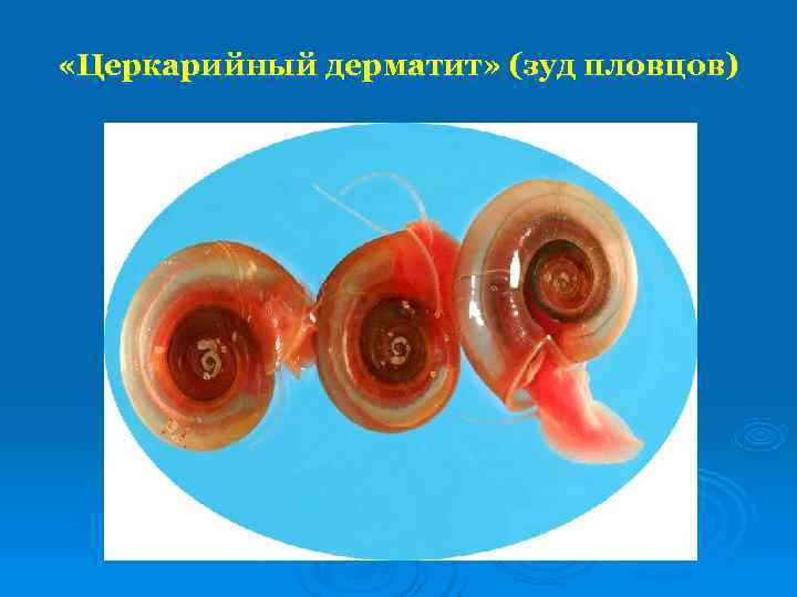  «Церкарийный дерматит» (зуд пловцов) 