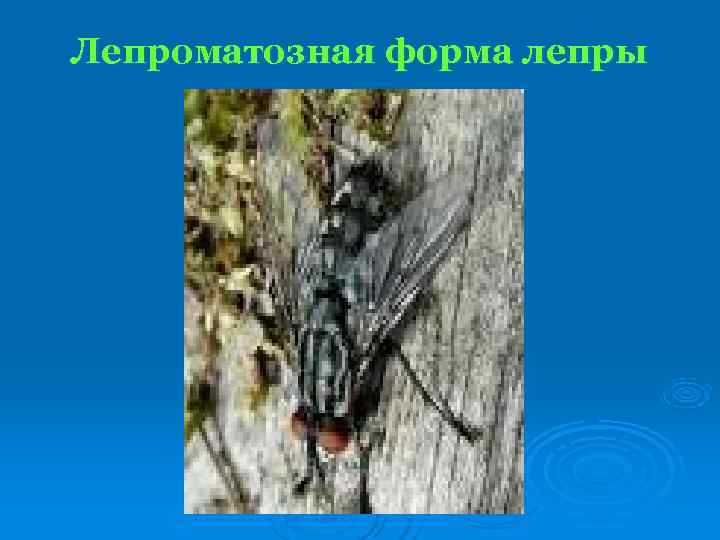 Лепроматозная форма лепры 