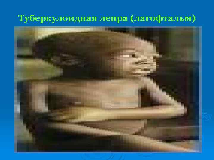 Туберкулоидная лепра (лагофтальм) 