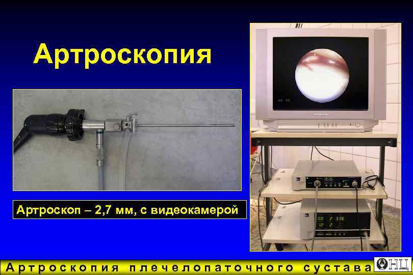   Артроскопия Артроскоп – 2, 7 мм, с видеокамерой  Артроскопия плечелопаточного сустава