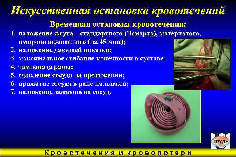 Искусственная остановка кровотечений  Временная остановка кровотечения: 1. наложение жгута – стандартного (Эсмарха), матерчатого,
