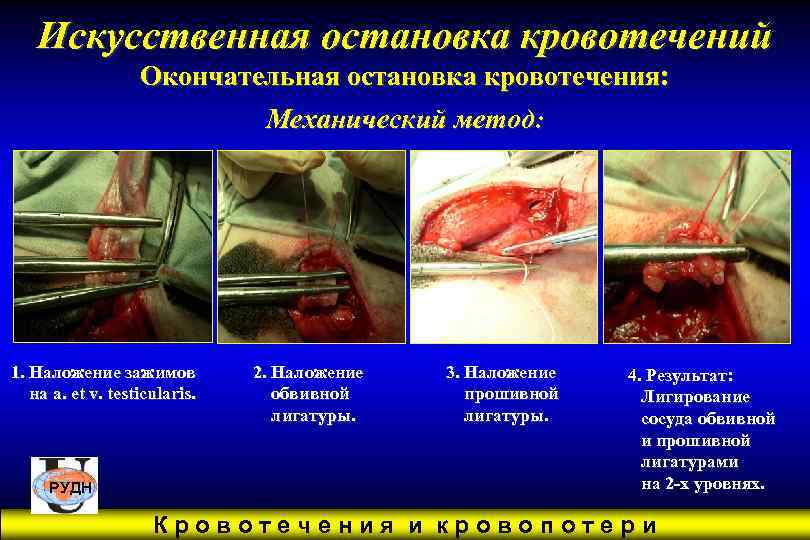   Искусственная остановка кровотечений    Окончательная остановка кровотечения:   