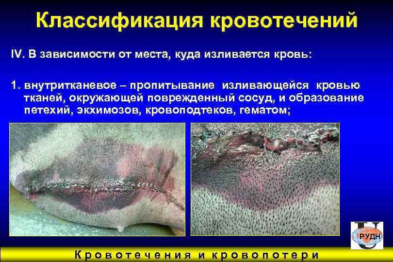  Классификация кровотечений IV. В зависимости от места, куда изливается кровь:  1.