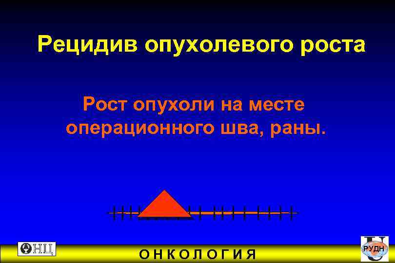 Рецидив опухолевого роста Рост опухоли на месте операционного шва, раны. РУДН ОНКОЛОГИЯ 