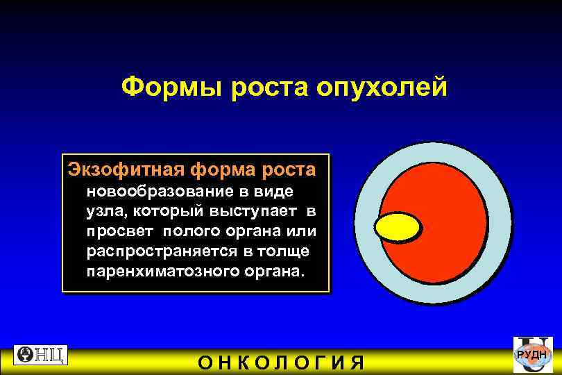  Формы роста опухолей Экзофитная форма роста новообразование в виде узла, который выступает в