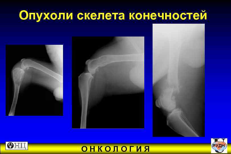 Опухоли скелета конечностей РУДН ОНКОЛОГИЯ 