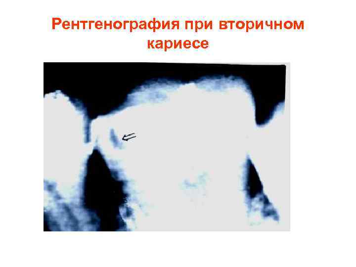 Рентгенография при вторичном  кариесе 
