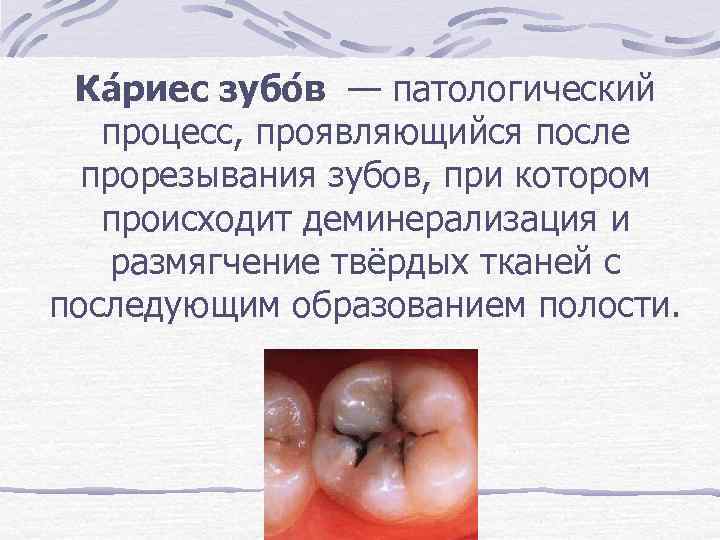  Ка риес зубо в — патологический процесс, проявляющийся после  прорезывания зубов, при