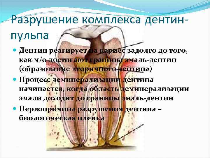 Разрушение комплекса дентин- пульпа  Дентин реагирует на кариес задолго до того,  как