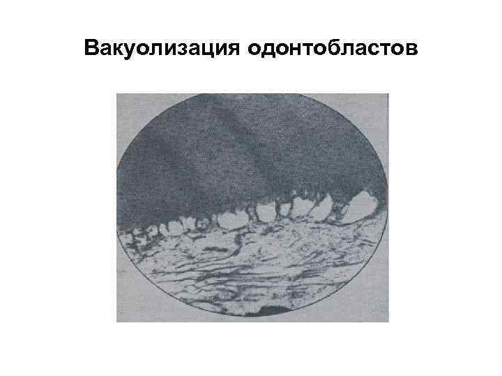 Вакуолизация одонтобластов 