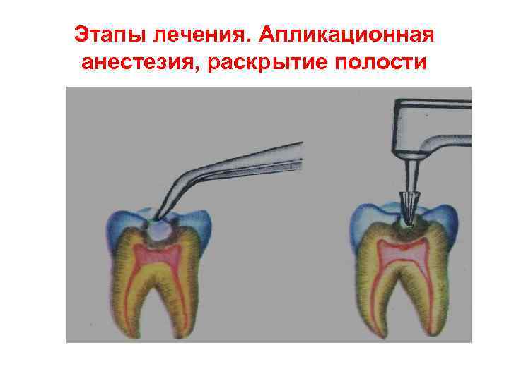 Этапы лечения. Апликационная анестезия, раскрытие полости 