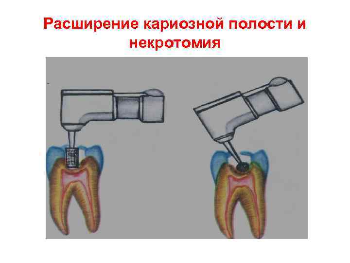 Расширение кариозной полости и   некротомия 