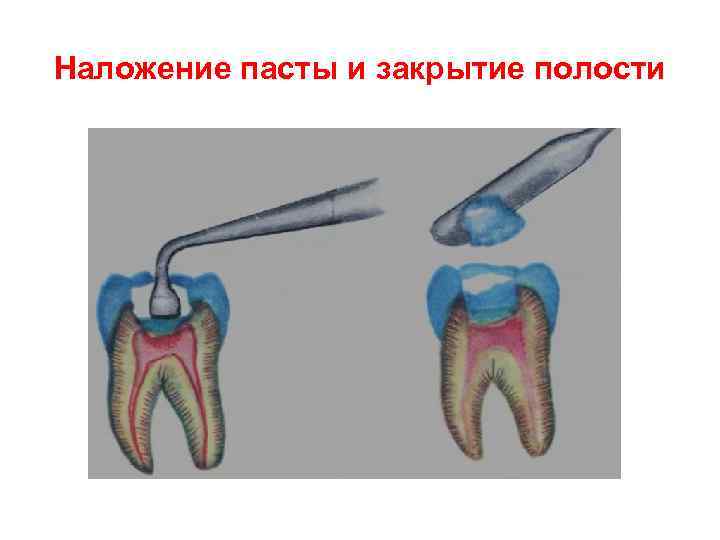 Наложение пасты и закрытие полости 