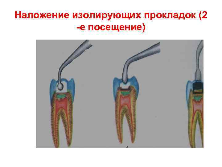 Схема наложения лечебных прокладок