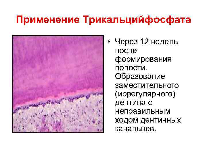 Применение Трикальцийфосфата   • Через 12 недель   после   формирования