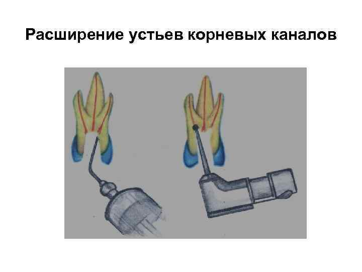 Расширение устьев корневых каналов 