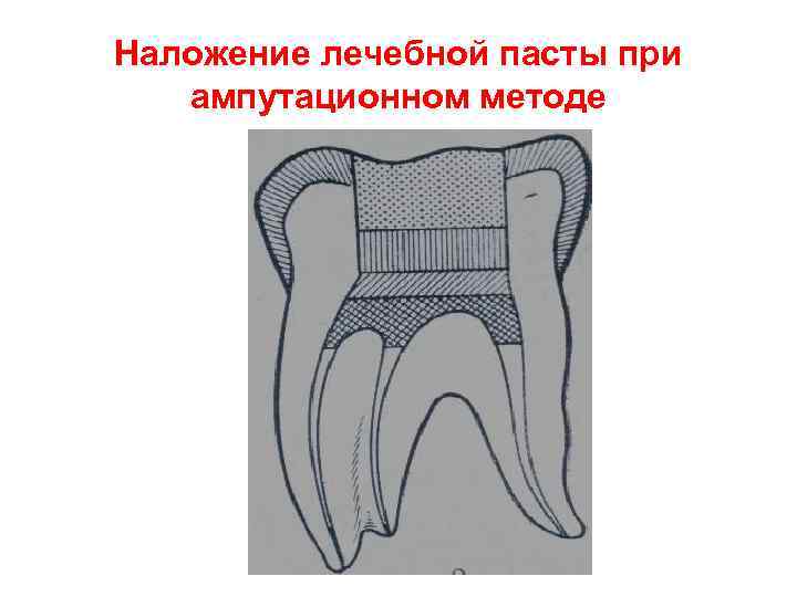 Наложение лечебной пасты при  ампутационном методе 