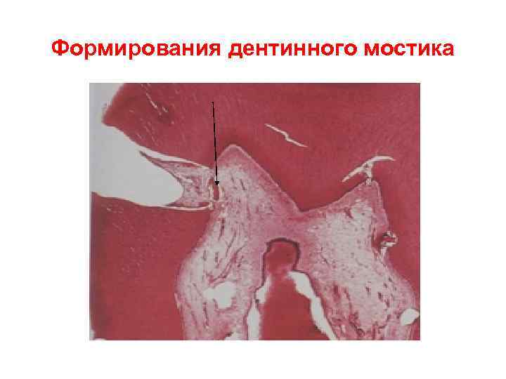 Формирования дентинного мостика 