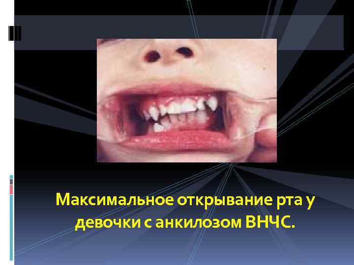 Максимальное открывание рта у  девочки с анкилозом ВНЧС. 