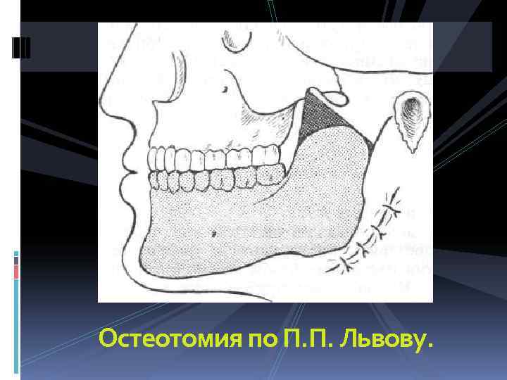 Остеотомия по П. П. Львову. 