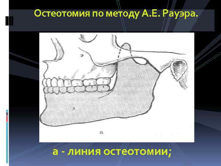 Остеотомия по методу А. Е. Рауэра.   а - линия остеотомии; 