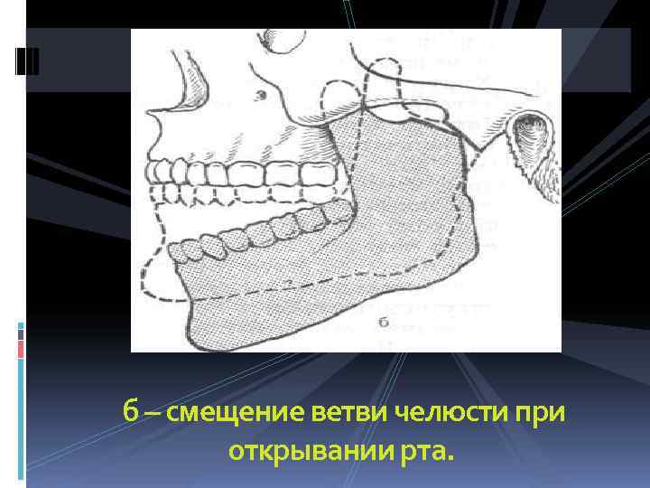 б – смещение ветви челюсти при   открывании рта. 