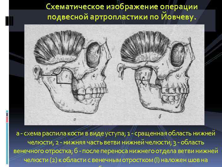    Схематическое изображение операции  подвесной артропластики по Йовчеву.  а -