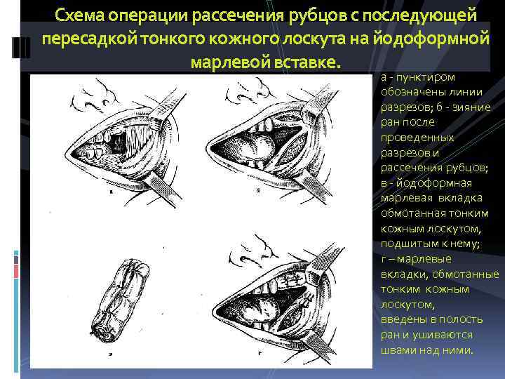  Схема операции рассечения рубцов с последующей пересадкой тонкого кожного лоскута на йодоформной 