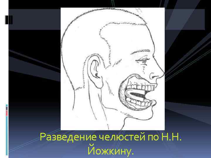 Разведение челюстей по Н. Н.   Йожкину. 