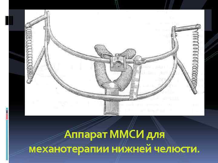  Аппарат ММСИ для механотерапии нижней челюсти. 