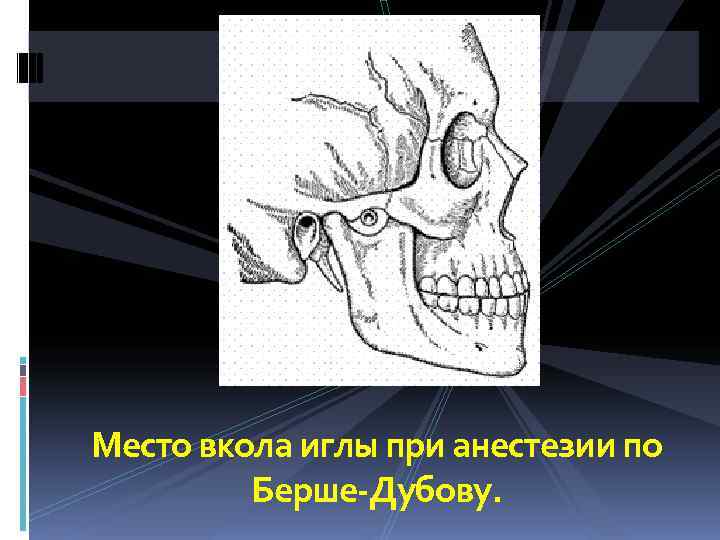 Место вкола иглы при анестезии по   Берше-Дубову. 