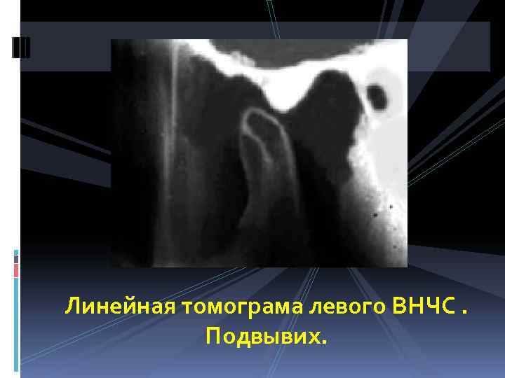 Линейная томограма левого ВНЧС.   Подвывих. 