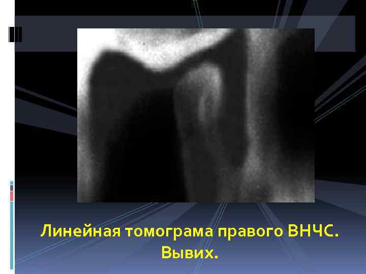 Линейная томограма правого ВНЧС.    Вывих. 