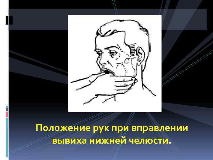 Положение рук при вправлении  вывиха нижней челюсти. 