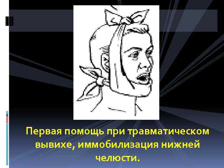 Первая помощь при травматическом вывихе, иммобилизация нижней   челюсти. 